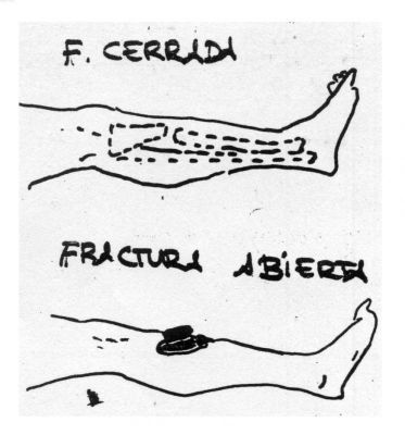 Fracturas.Cerradas y abiertas.Bolós.
